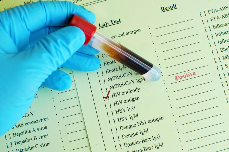 Result of HIV antibody testing, the result showed positive
** Note: Visible grain at 100%, best at smaller sizes